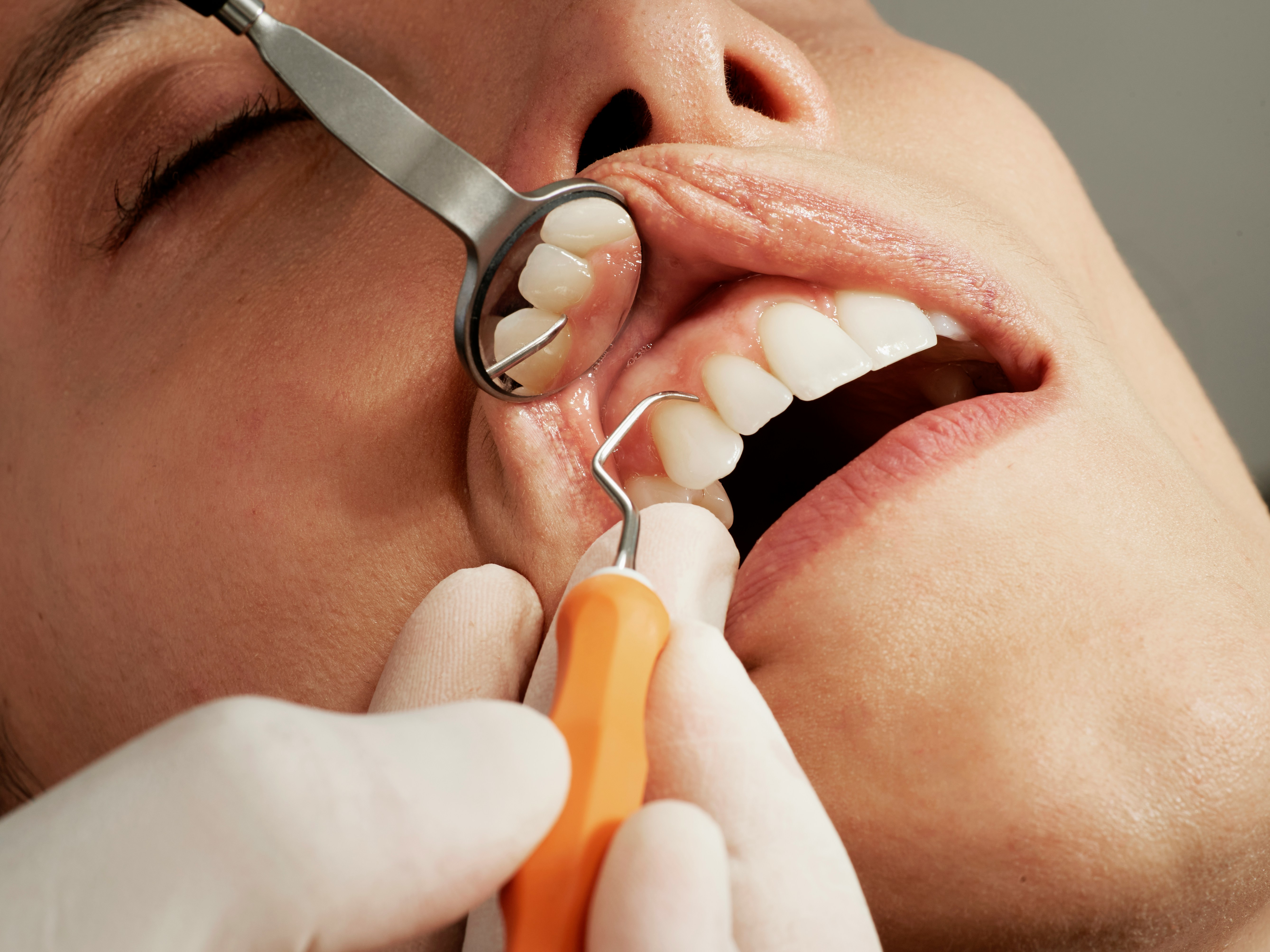 Dental Crowns and Bridges at ORO-Care Dental Clinic