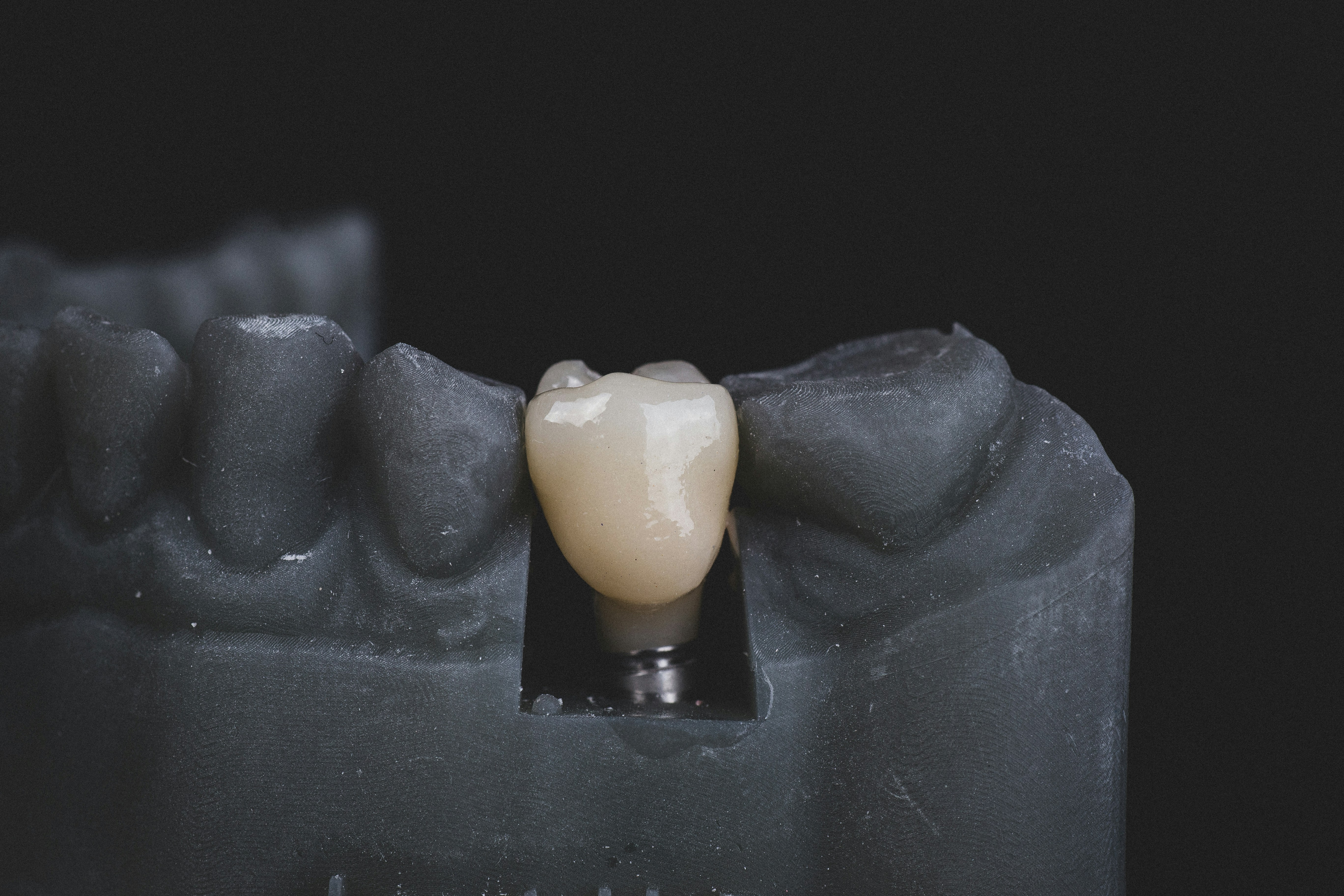 Dental Implants at ORO-Care Dental Clinic