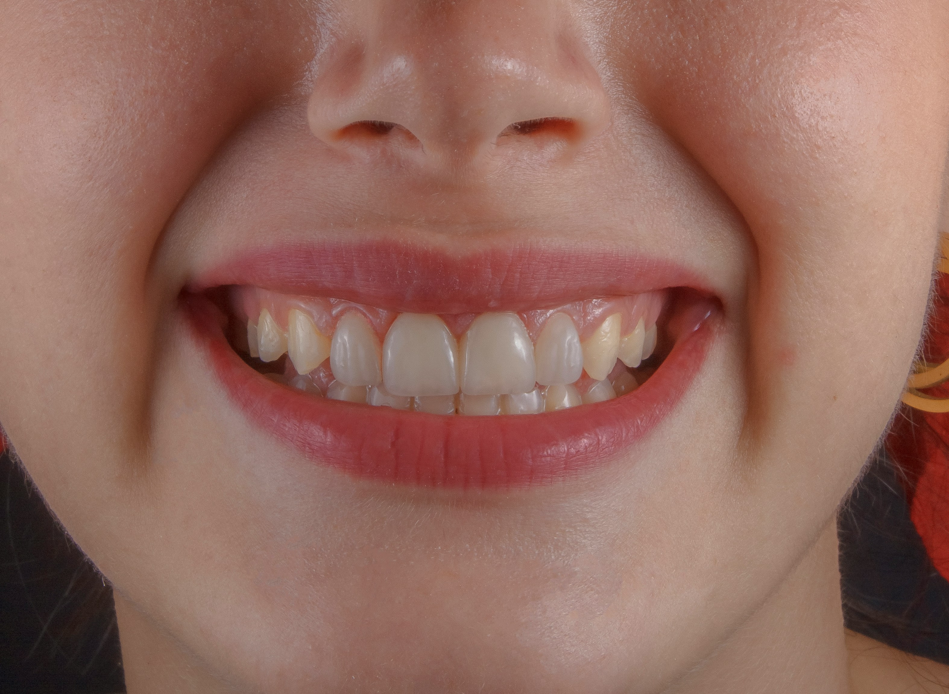 Smile Designing at ORO-Care Dental Clinic