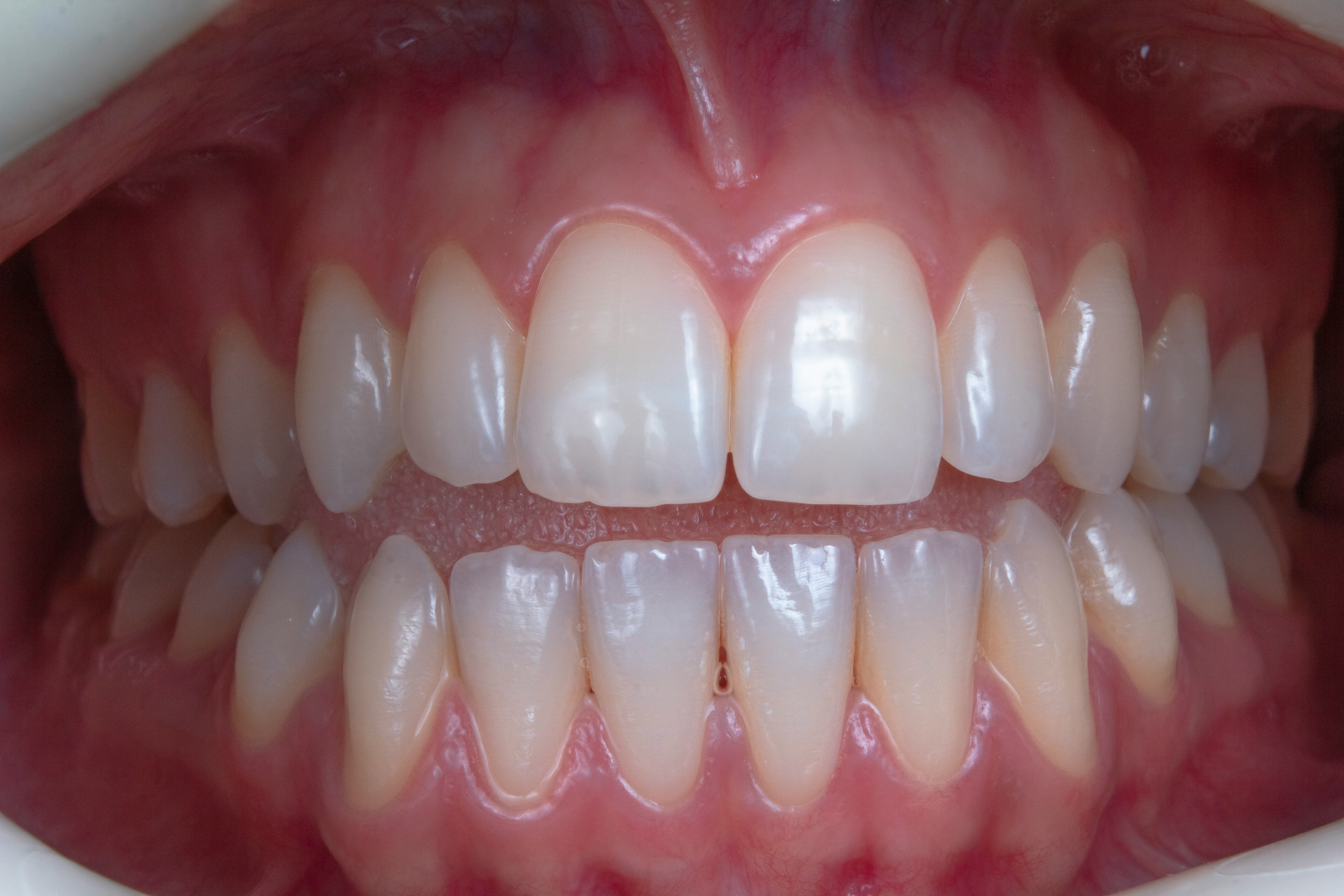 Professional Tooth Whitening at ORO-Care Dental Clinic